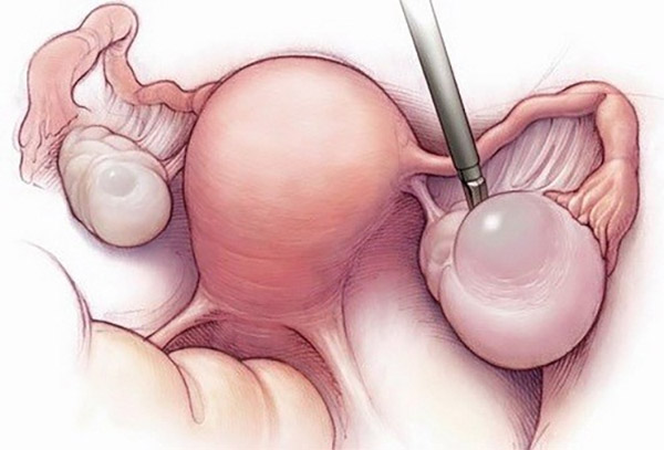 Mổ u nang buồng trứng sẽ được chỉ định khi kích thước khối u lớn hơn 5 - 10cm